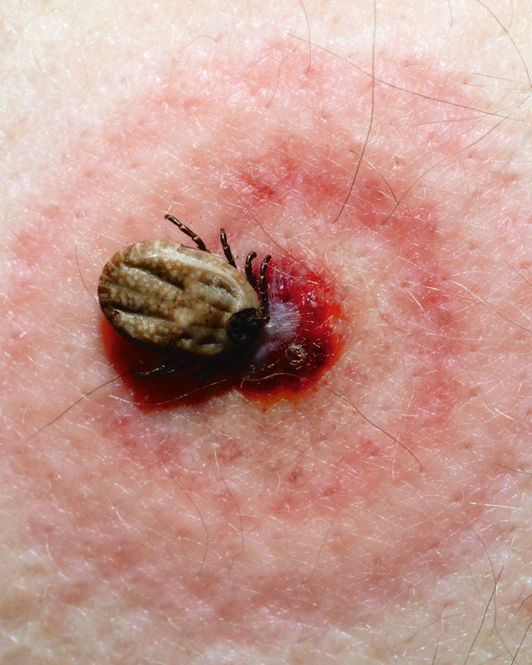 Maladie de Lyme : symptômes à surveiller après une piqûre de tique ...