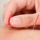 acupuncture medecine chinoise