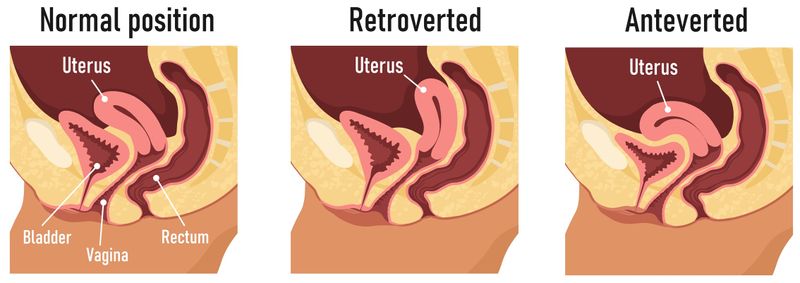 Schéma utérus antéversé rétroversé